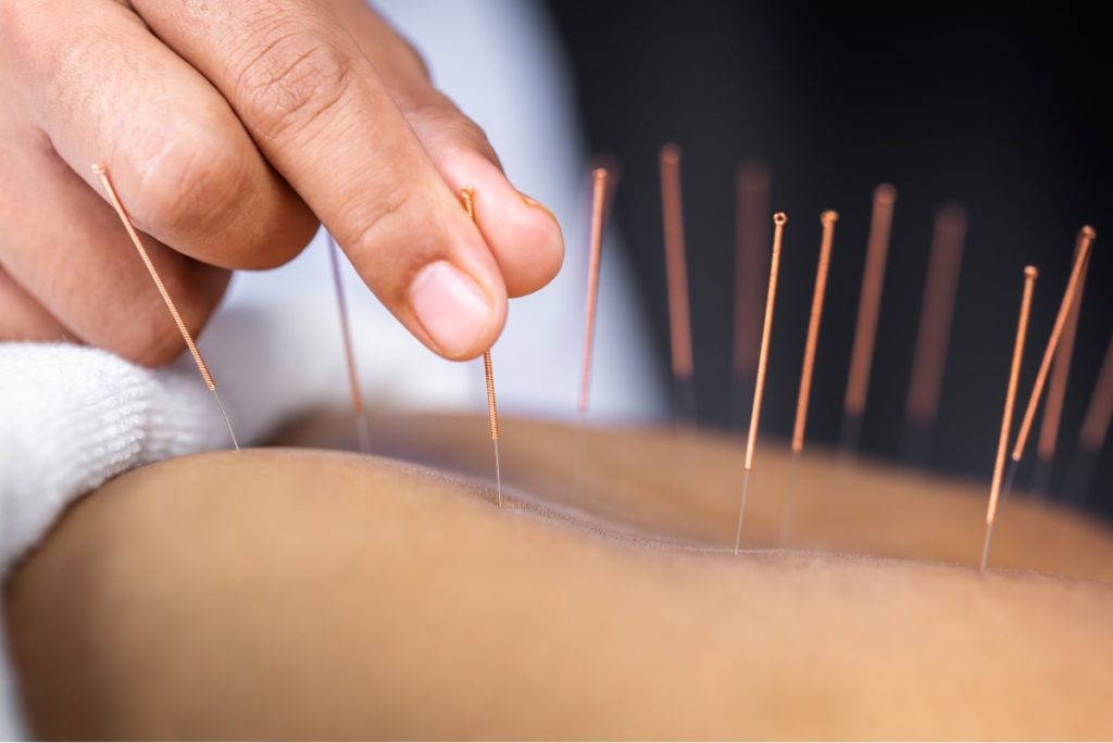 close up of practitioner putting acupuncture needles into clients back