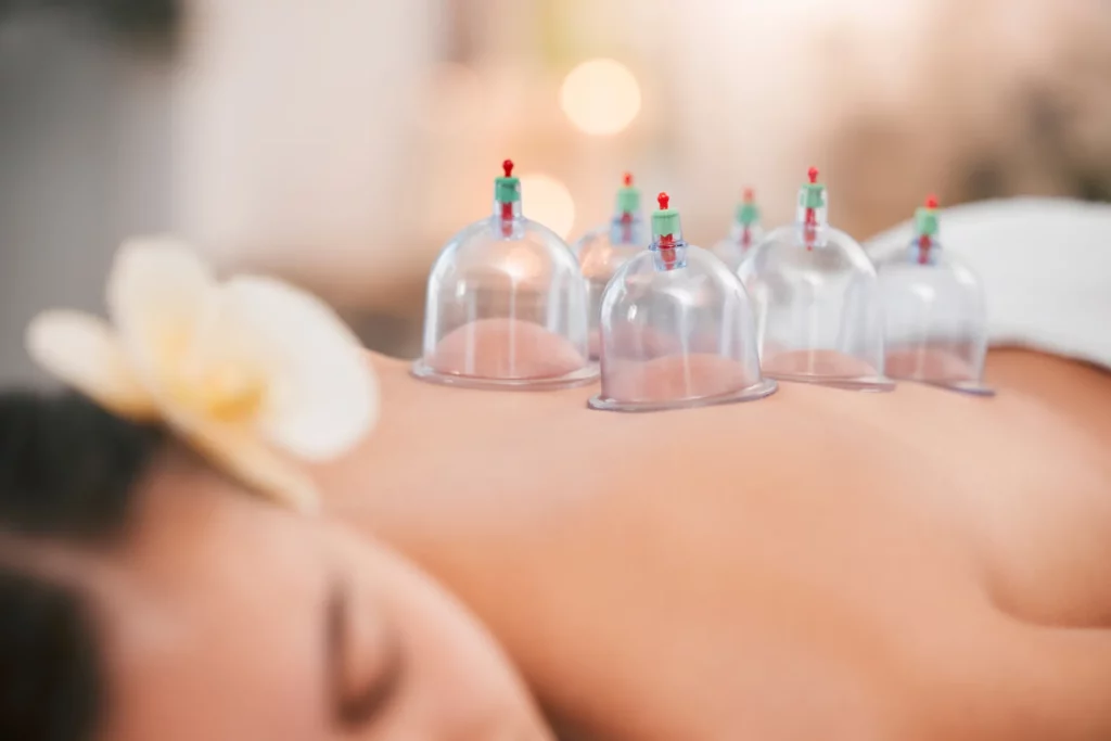 A close-up image of a cupping treatment on a client's back.