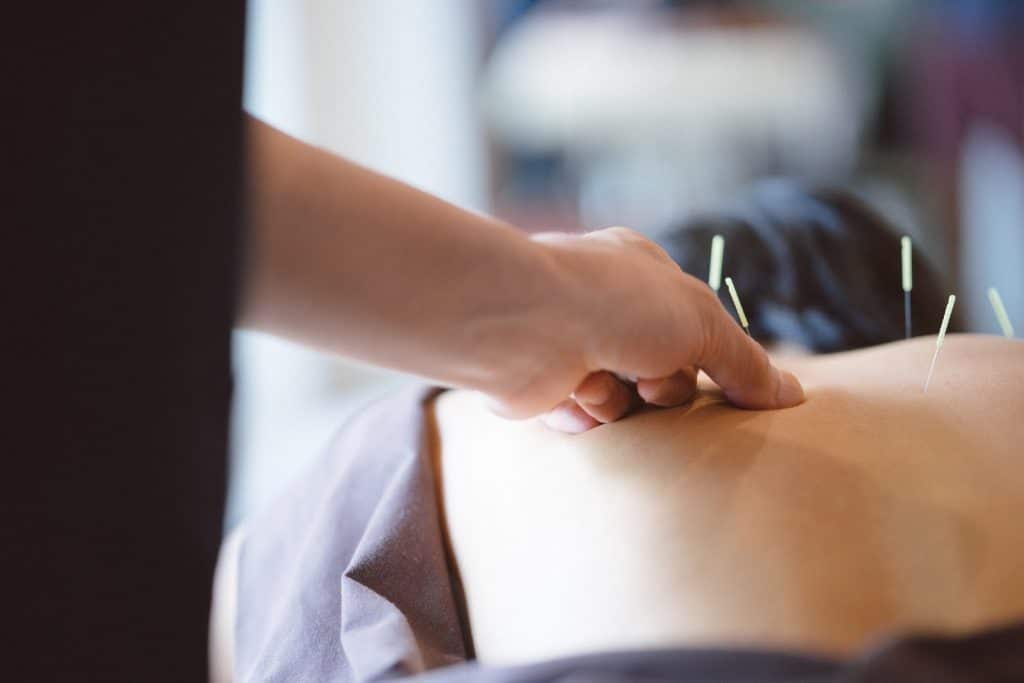 Patient receiving acupuncture treatment
