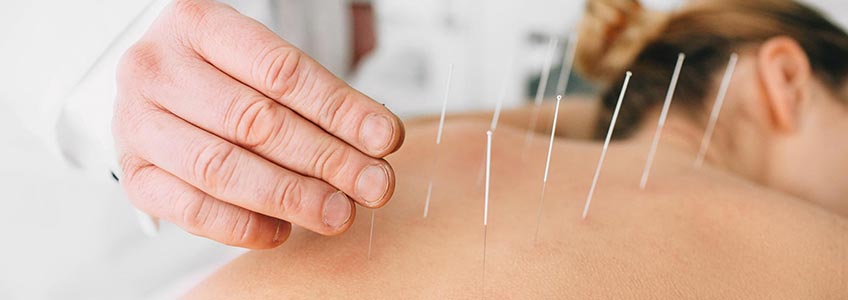 acupuncturist placing needles into woman's back