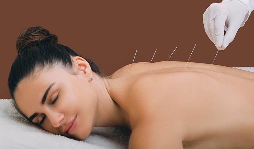acupuncture therapist placing needles in line on woman's back