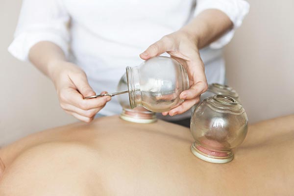 therapist placing cups on woman's back