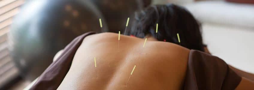 woman with acupuncture needles in her back
