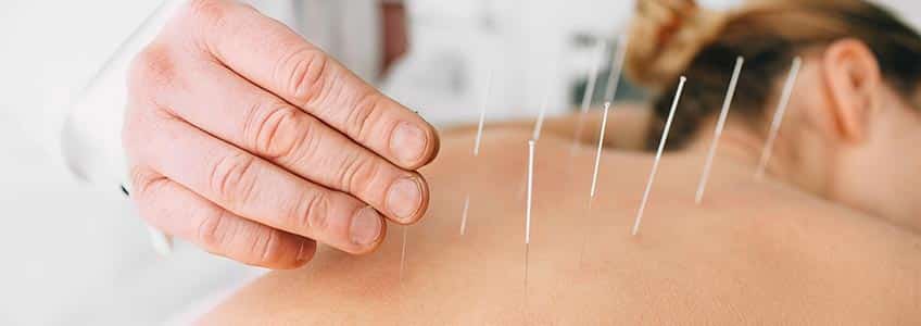 acupuncturist placing needles in woman's back